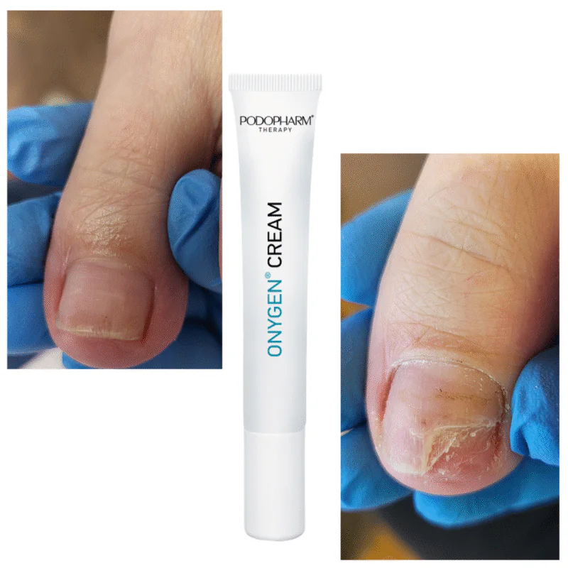 ONYGEN CREAM, onühholüüsi kreem (20ml) - Image 2