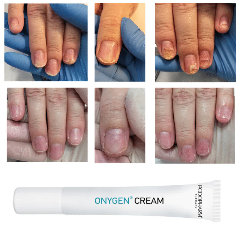 ONYGEN CREAM, onühholüüsi kreem (20ml) - Image 4