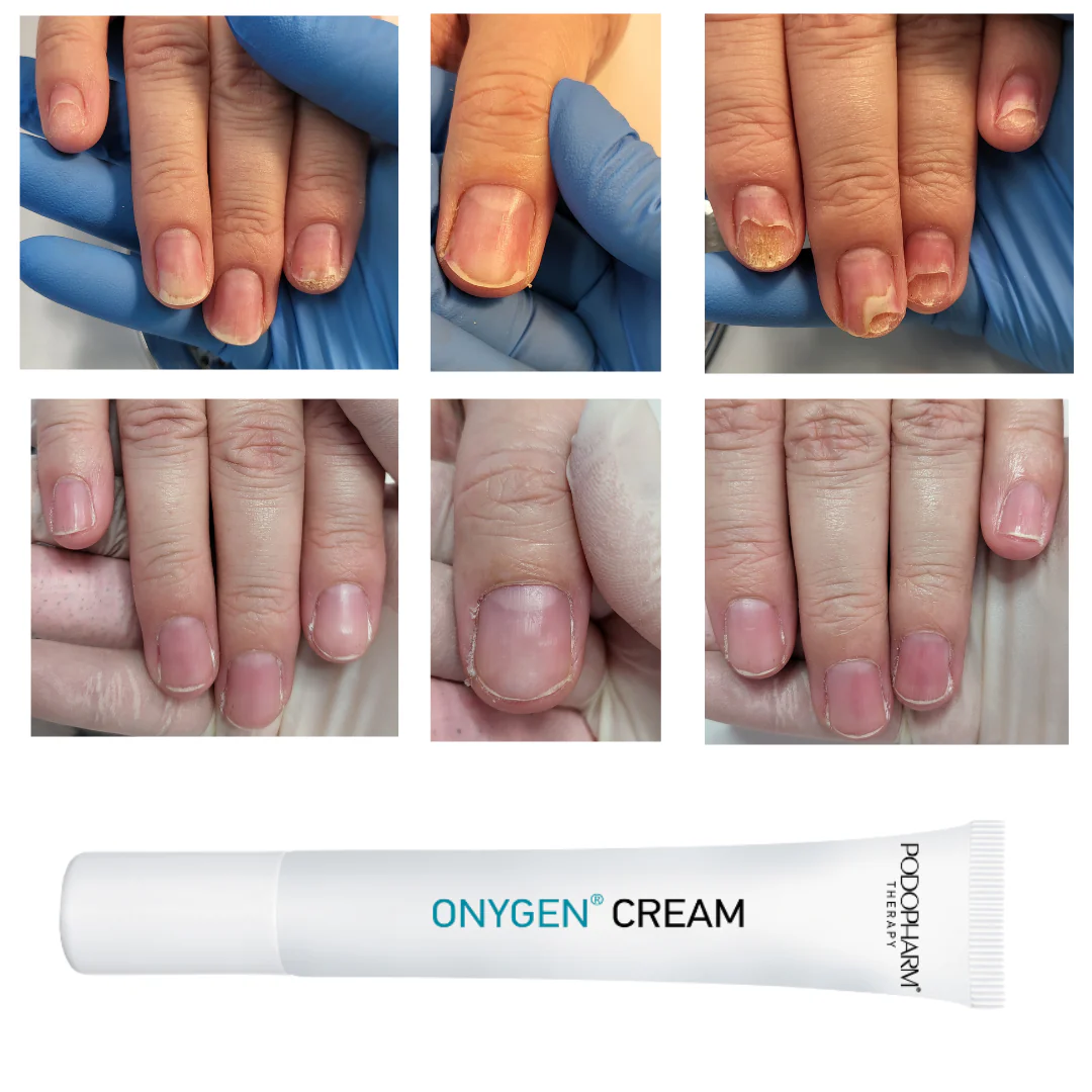 ONYGEN CREAM, onühholüüsi kreem (20ml) - Image 4