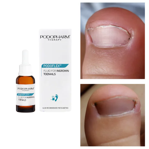 Fluid For Ingrown Toenails, sissekasvanud küünte vedelik (10ml) - Image 2