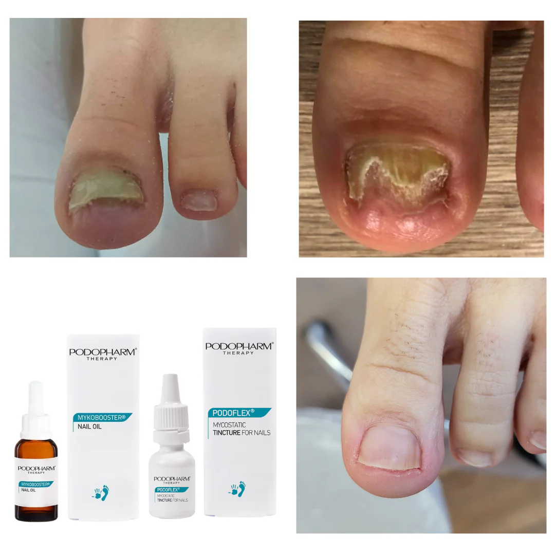 MYKOBOOSTER Nail Oil, seenevastane küüneõli (10ml) - Image 2